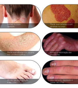 PSORIASE 2