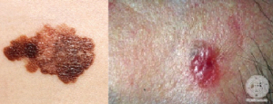 melanoma